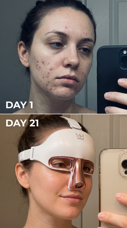 ONIRLUX LED LUMIÈRE Therapy Mask